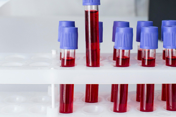 Indetectable = Intransmisible: el rol del laboratorio en el cuidado integral del VIH