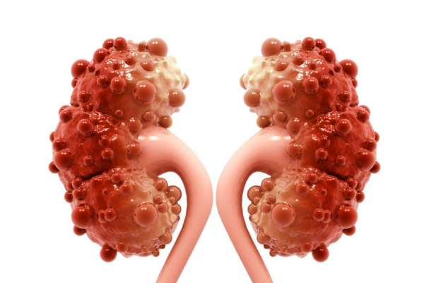 Poliquistosis renal: cómo ayuda la PCR a confirmar el diagnóstico