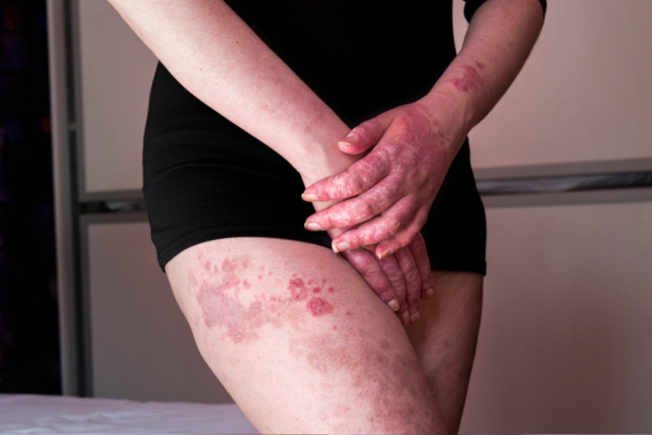 Lupus, fertilidad y embarazo: lo que hay que saber para una planificación segura
